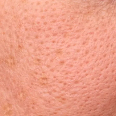 Pores dilatés